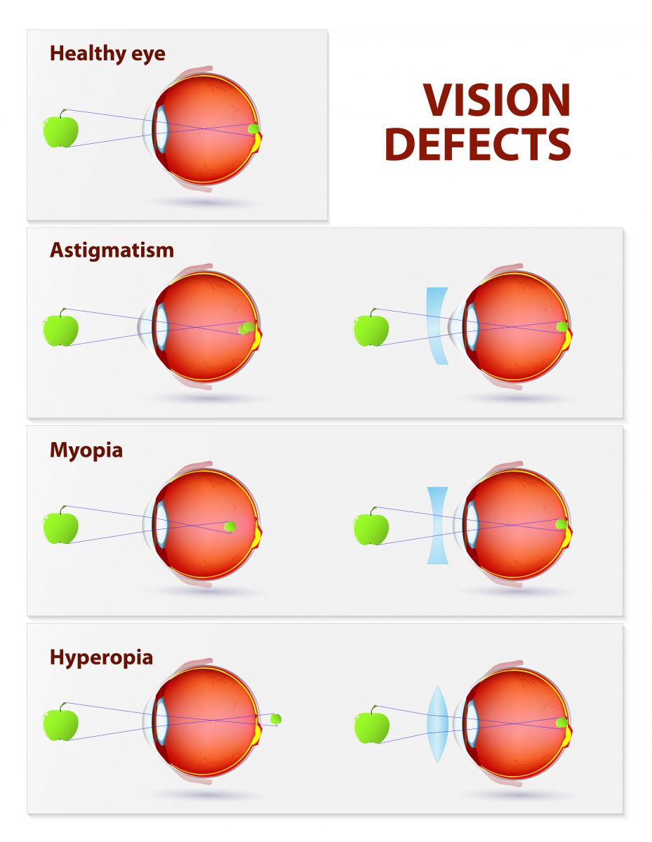 Refractive Errors Of The Eye Inn African Adults